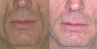 Lipofilling