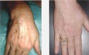 Peeling all'acido glicolico